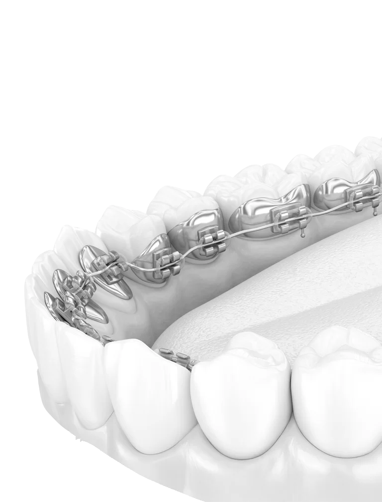 Lingual Braket Tedavisi