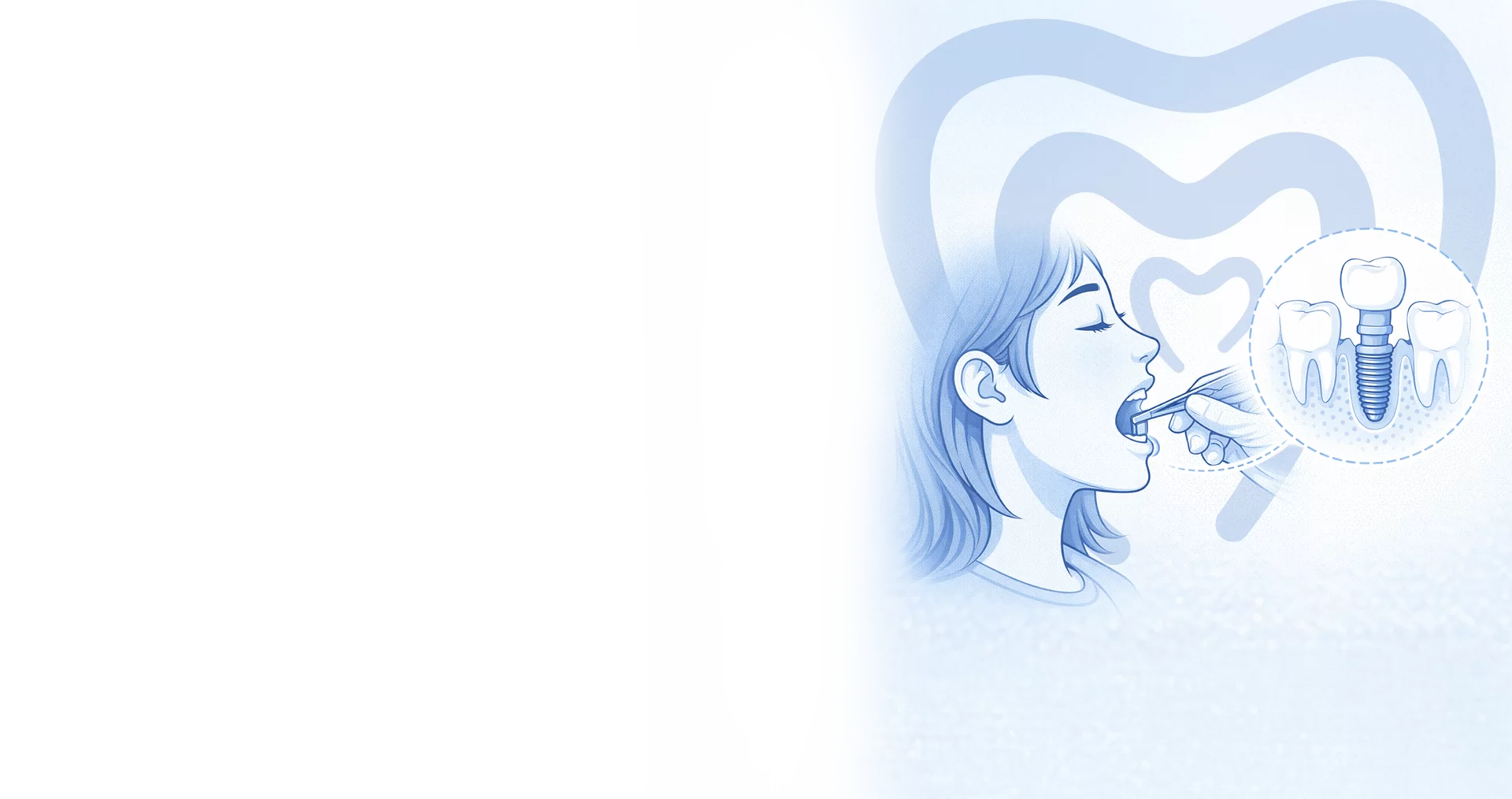 Dental İmplant Nedir? Kimler İçin Uygundur?